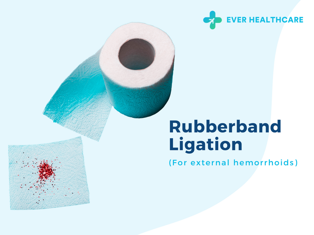 Rubberband Ligation for external hemorrhoids in Thailand 2023 Compare